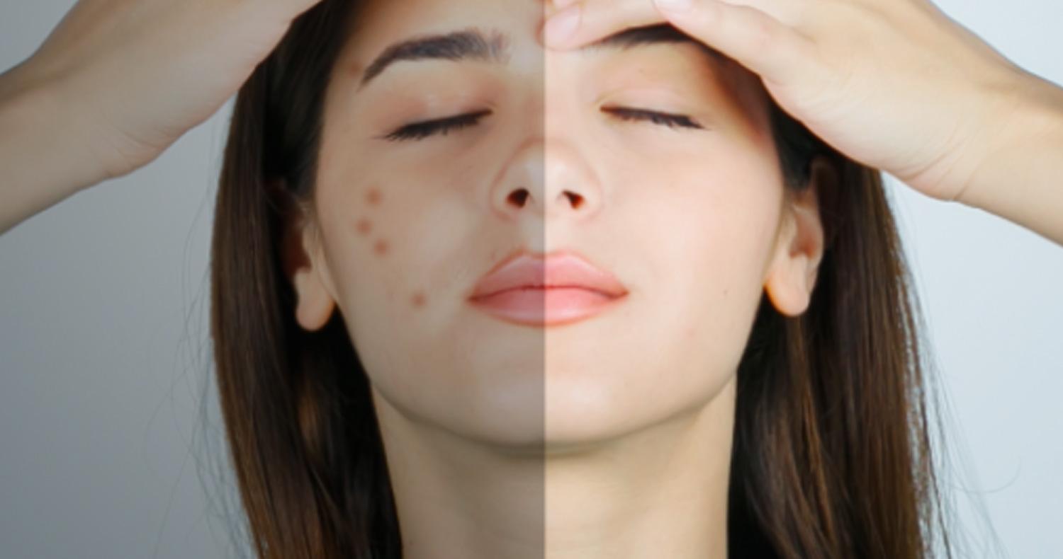 حذف جوش ، خال و زخم از صورت با Pimple Eraser